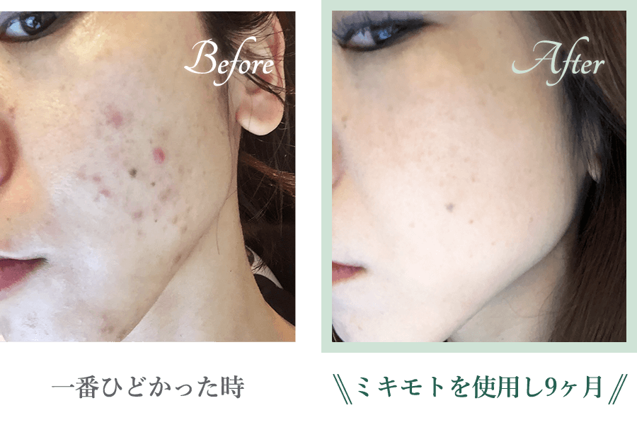 大人ニキビについて